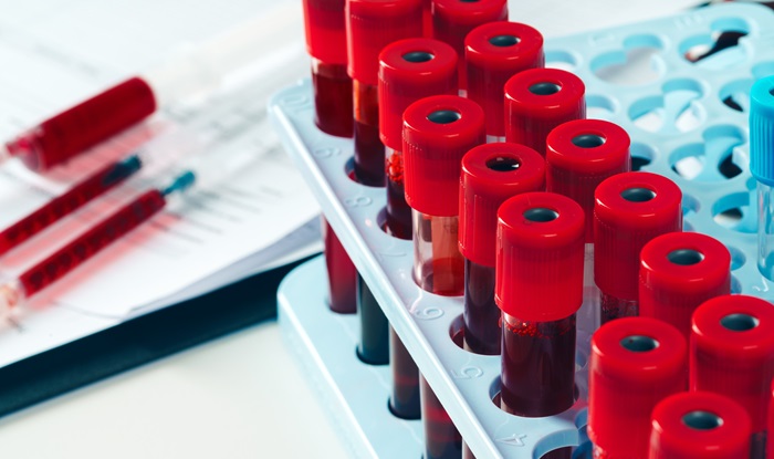 Image: The experimental blood test estimates age-related disease risk in diverse populations (Photo courtesy of 123RF)